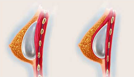 prótesis de aumento mamario Túnez