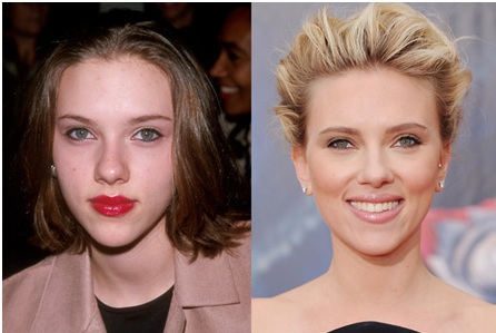 rhinoplastie Scarlett Johansson