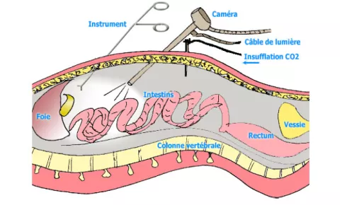 chirurgie par coelioscopie