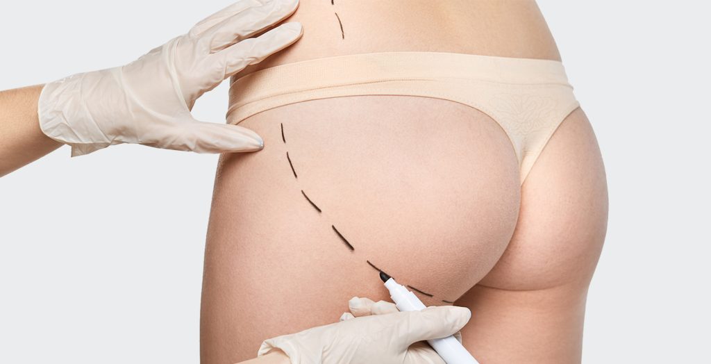 Tarifs d’une chirurgie esthétique liposuccion fesses à Paris