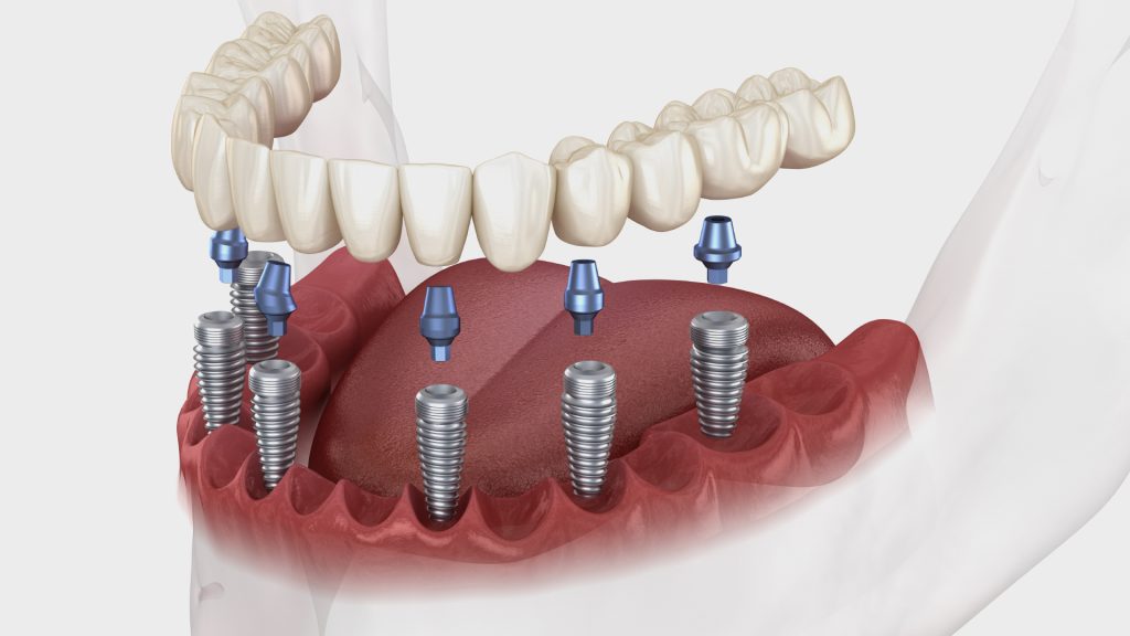 pose implant dentaire en France