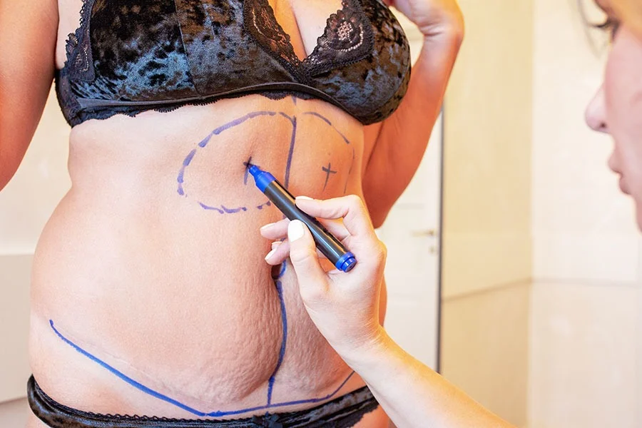 Réduction mammaire et abdominoplastie après grossesse