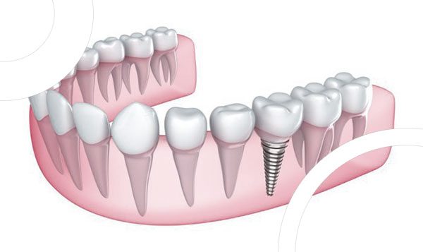 implant dentaire lyon