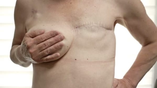 reconstruction-mammaire-marseille